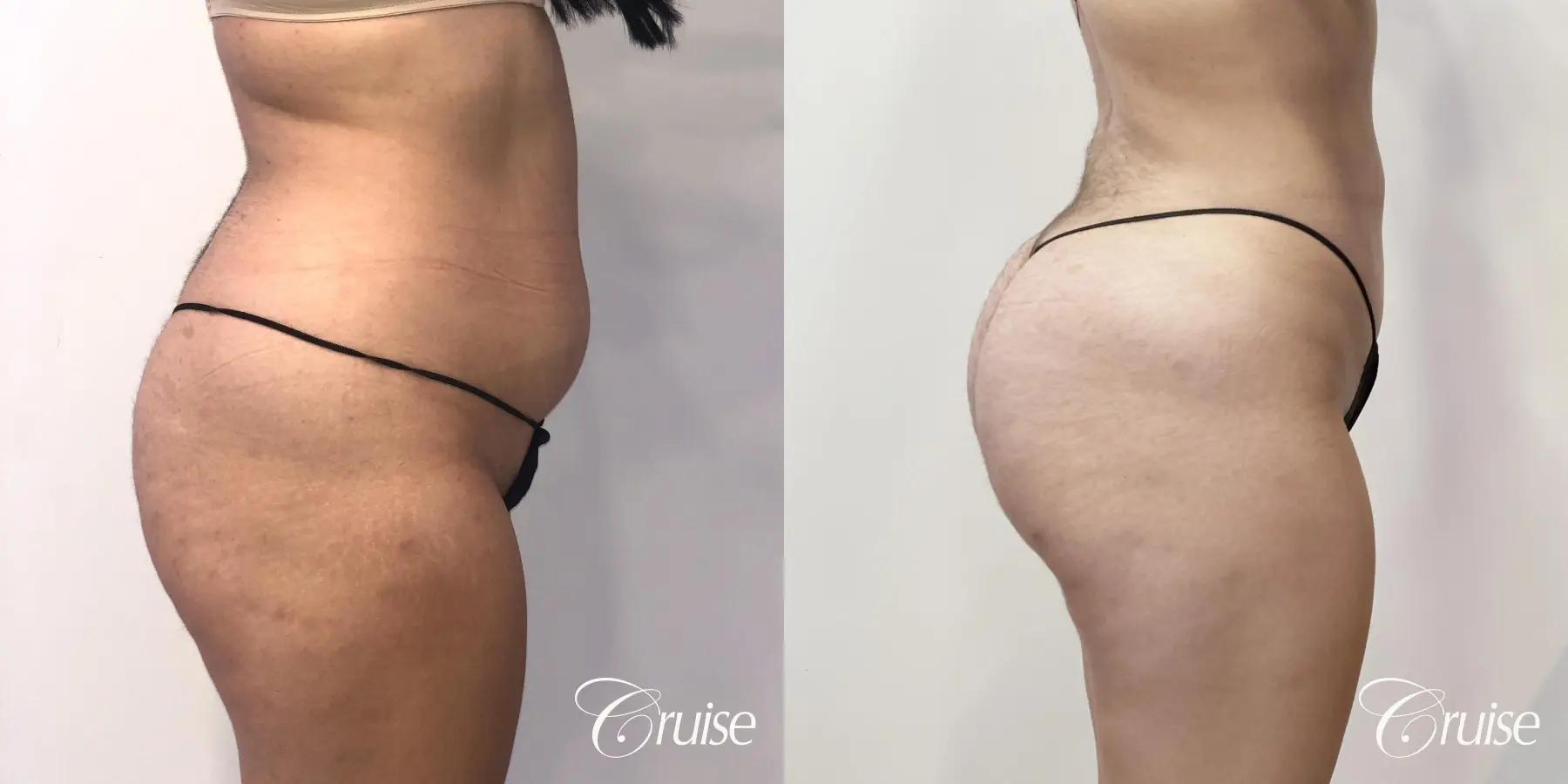 Brazilian Butt Lift: Patient 23 - Before and After 4
