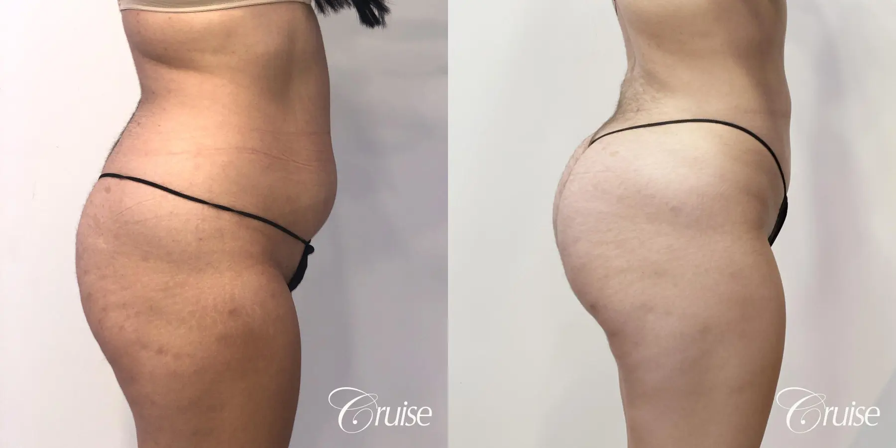 Brazilian Butt Lift: Patient 25 - Before and After 4