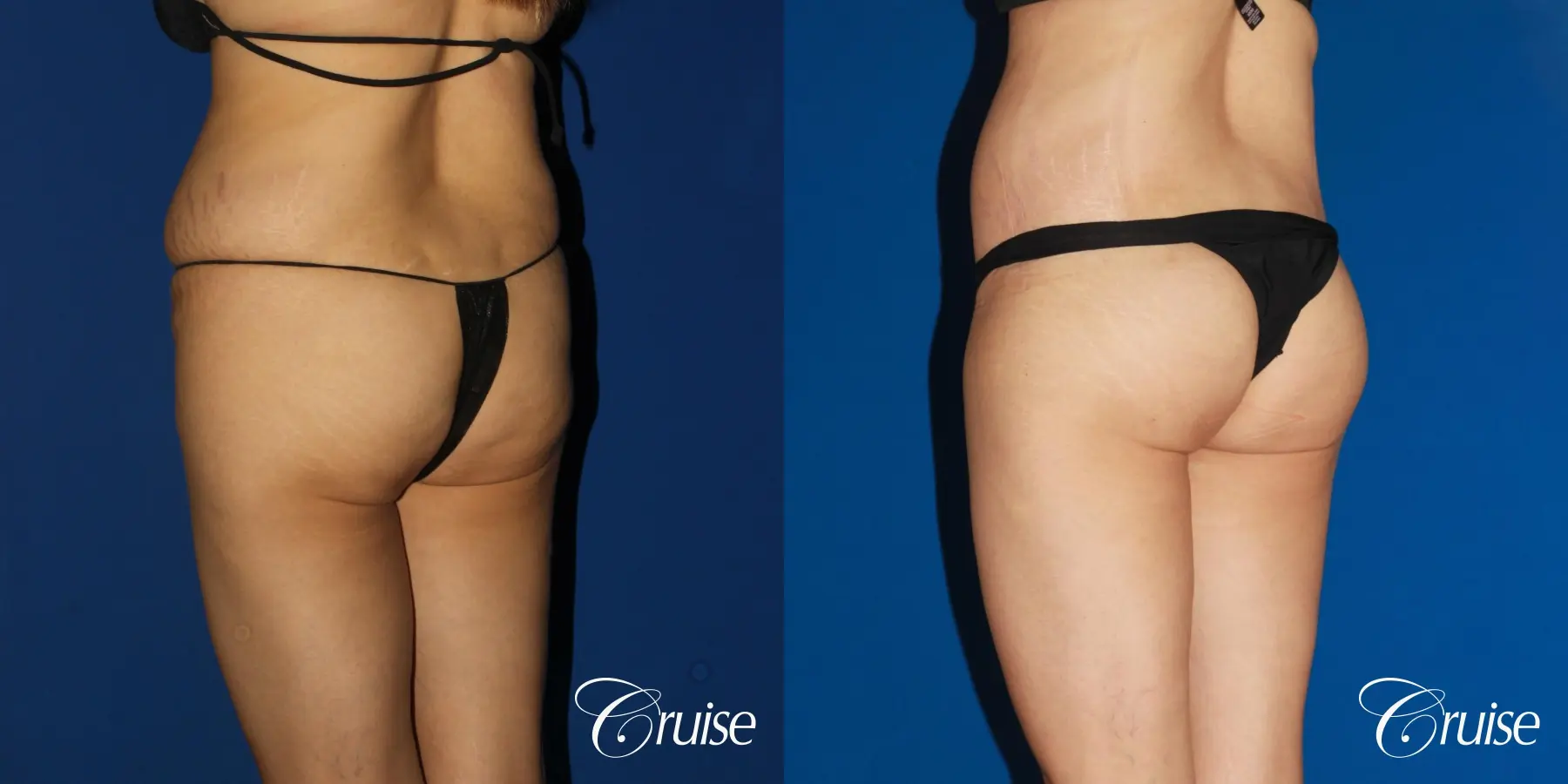 BBL, Lipo Flanks and Circumferential Tummy Tuck - Before and After 2