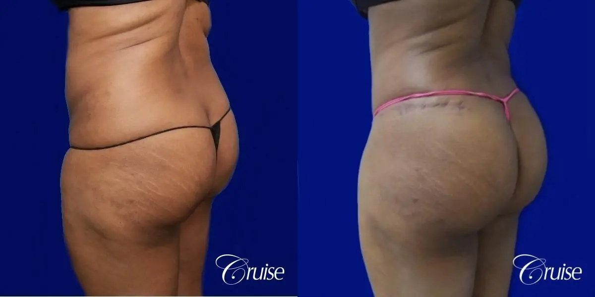 Brazilian Butt Lift  - Before and After 2