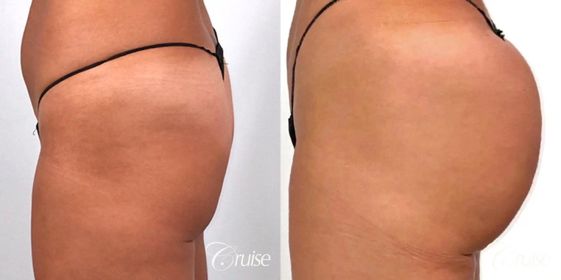 Brazilian Butt Lift with Liposuction to Stomach & Flanks - Before and After 5