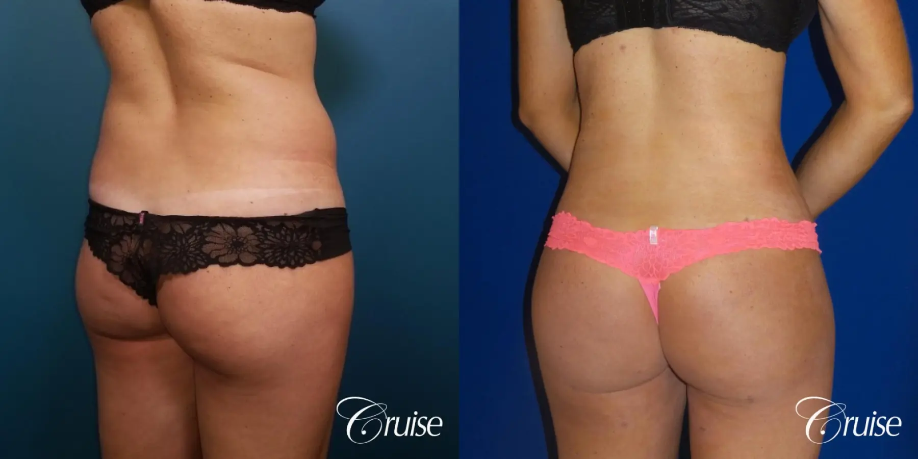 Brazilian Butt Lift: Patient 4 - Before and After 2