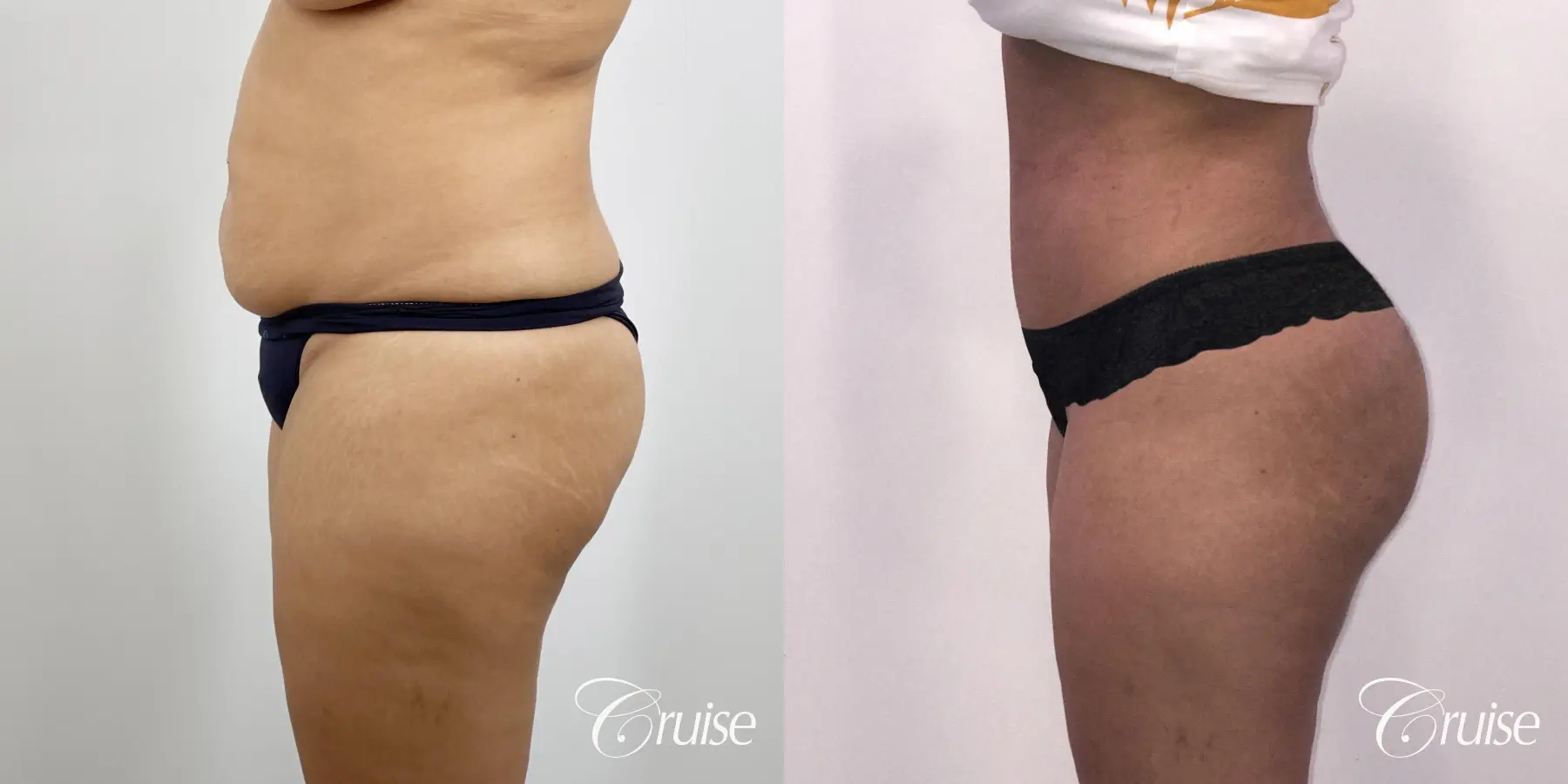 Brazilian Butt Lift: Patient 22 - Before and After 2