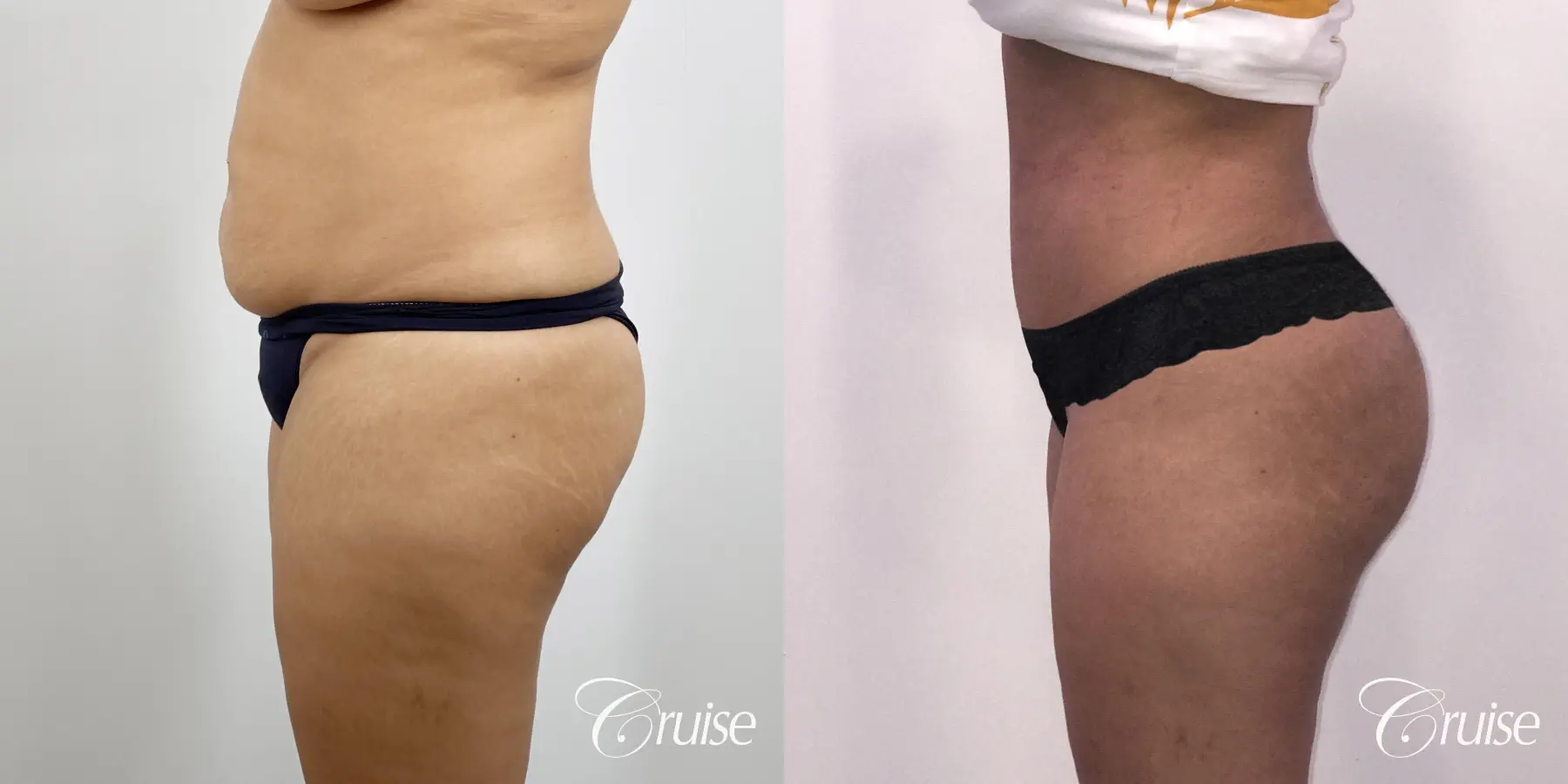 Brazilian Butt Lift: Patient 25 - Before and After 2