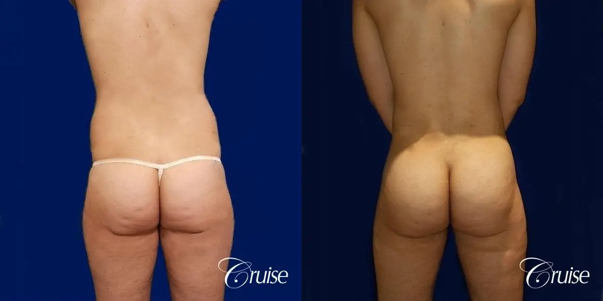 Brazilian Butt Lift - Before and After  