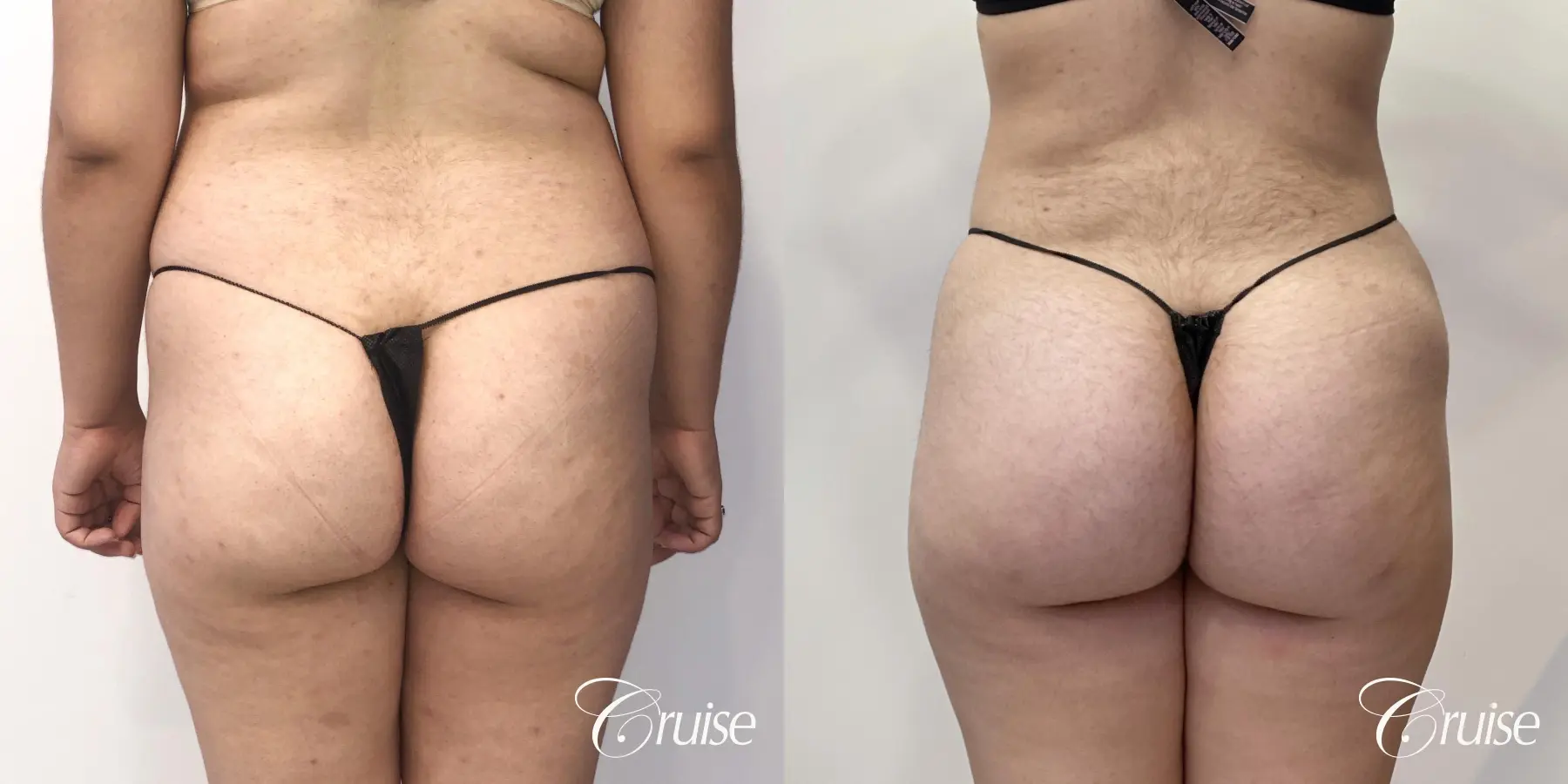 Brazilian Butt Lift: Patient 23 - Before and After 3