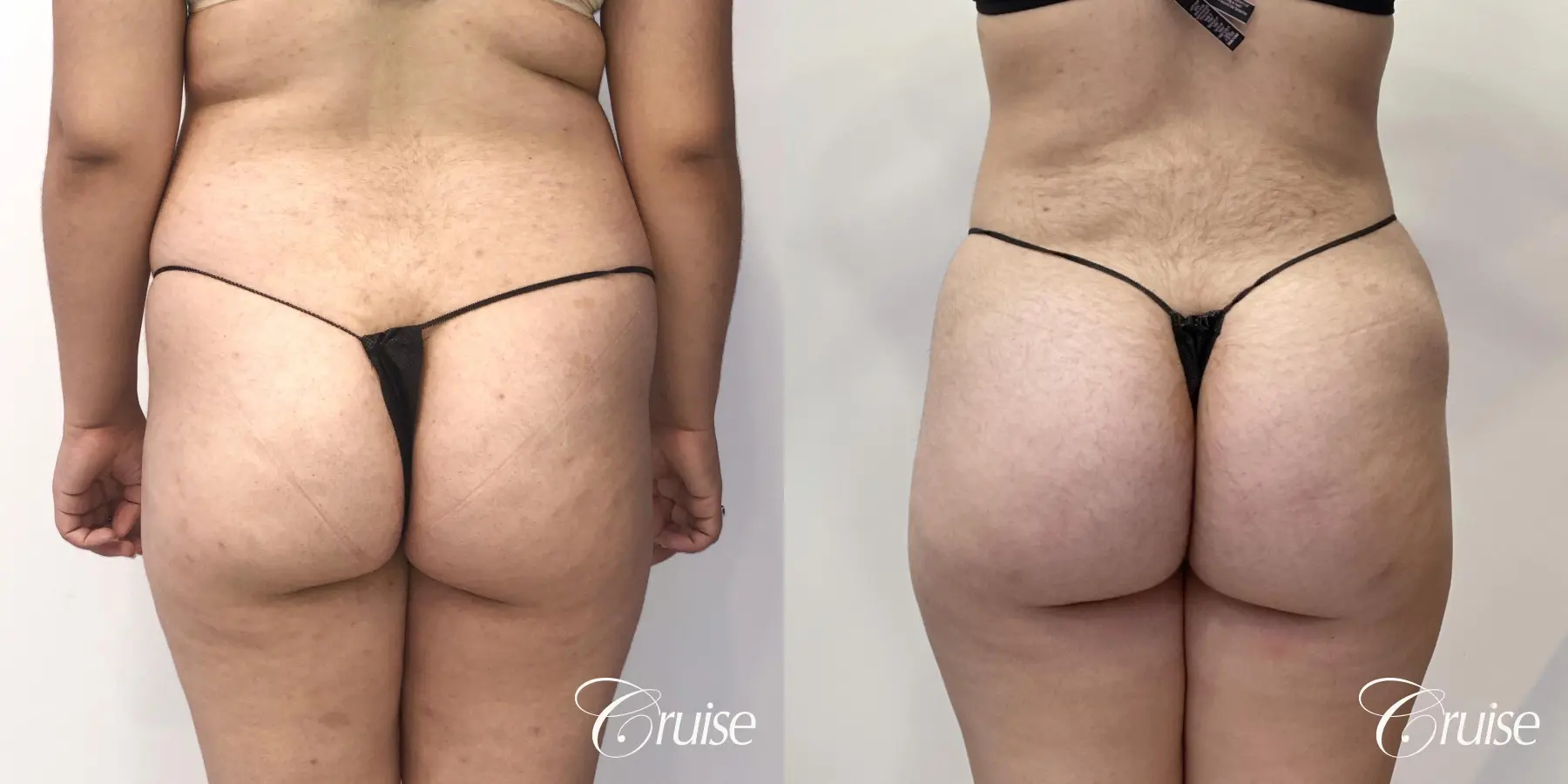 Brazilian Butt Lift: Patient 25 - Before and After 3