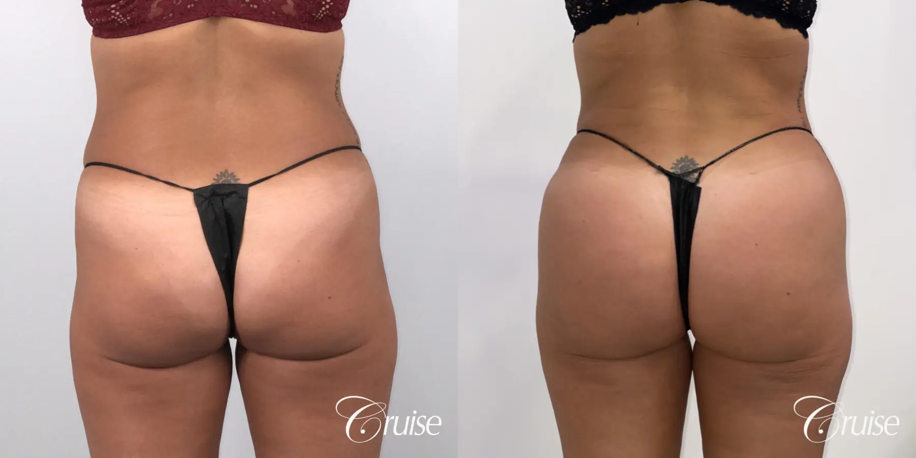Brazilian Butt Lift: Patient 28 - Before and After 3