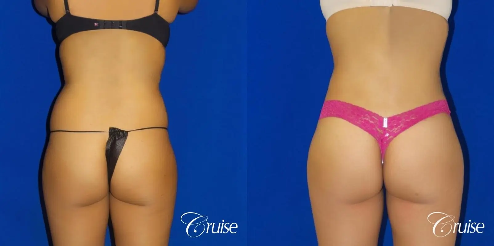 Brazilian Butt Lift - Before and After  