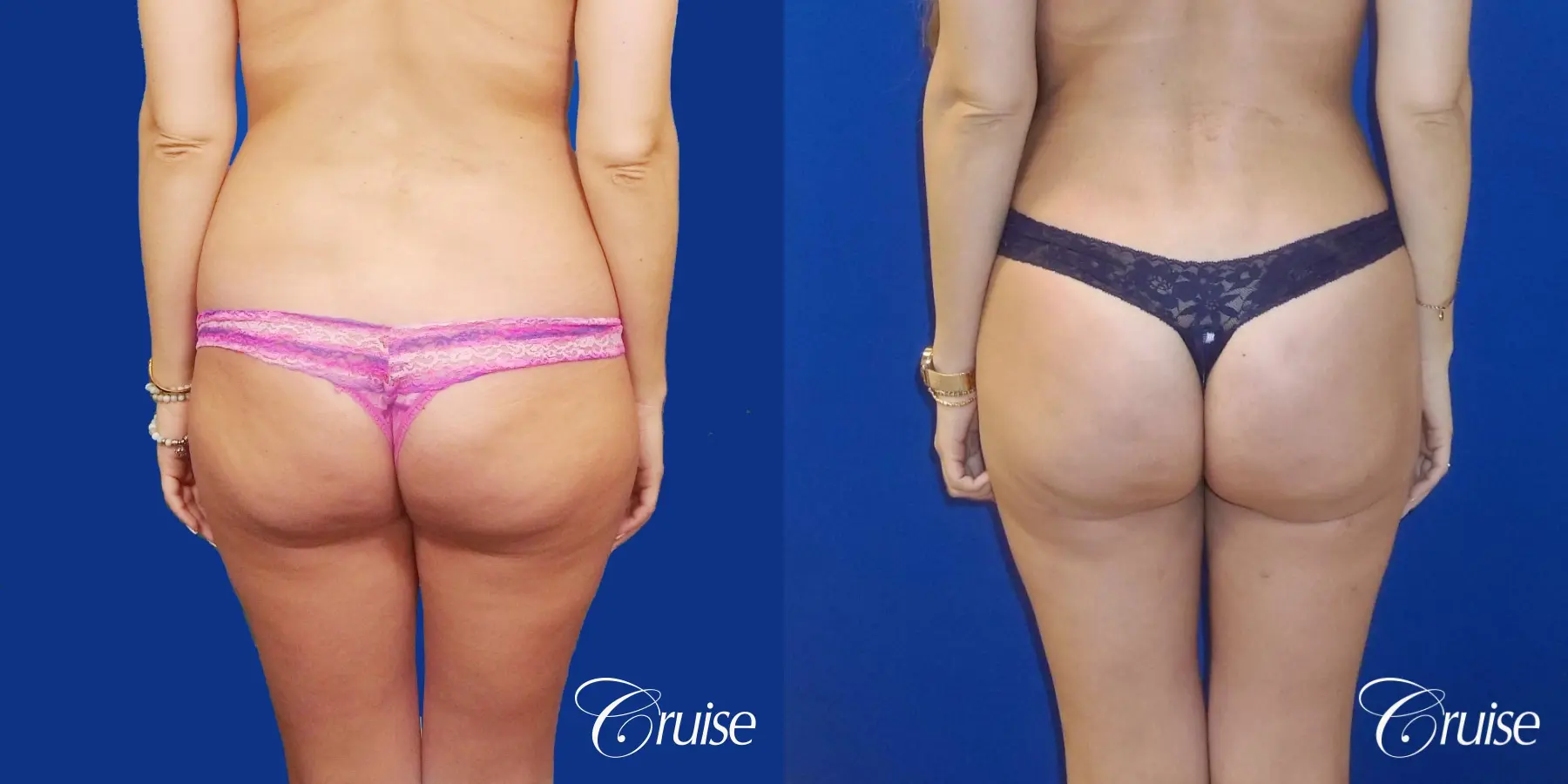 Brazilian Butt Lift (BBL) - High Valley Dermatology