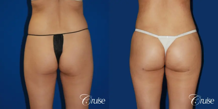 best bbl in newport beach - Before and After