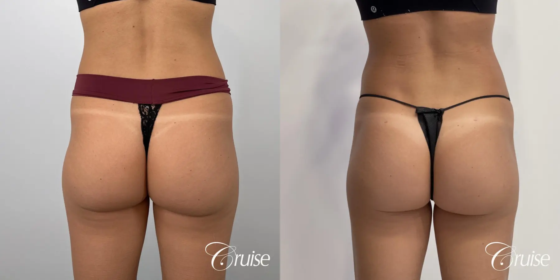 Brazilian Butt Lift: Patient 21 - Before and After 3