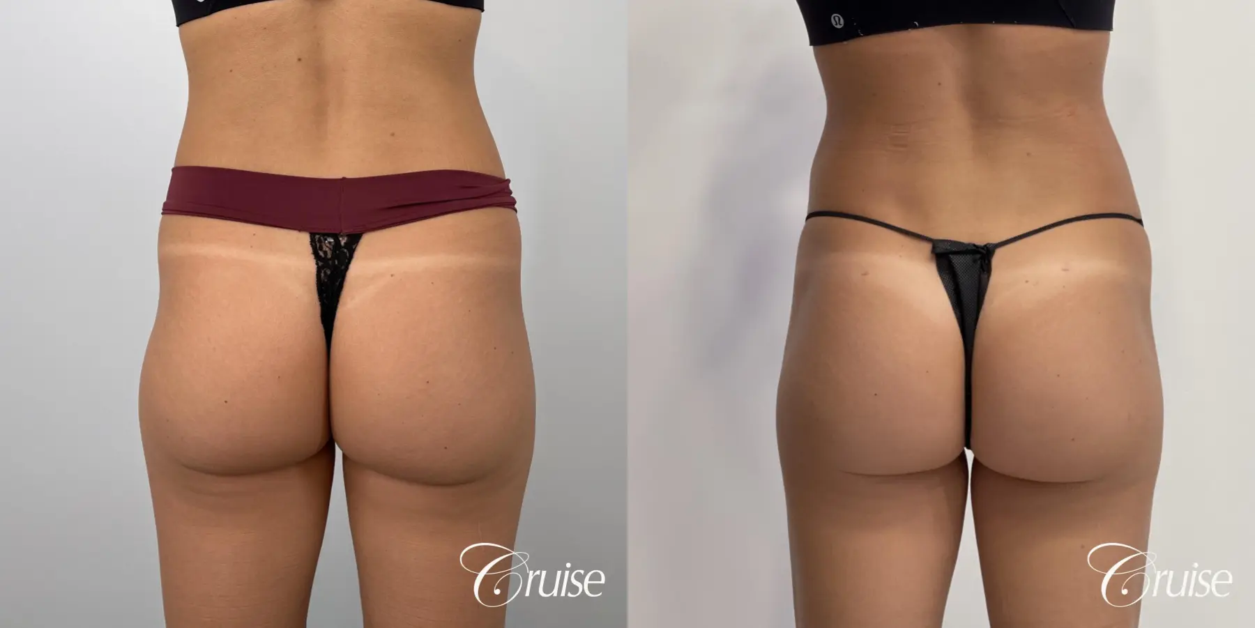 Brazilian Butt Lift: Patient 23 - Before and After 3