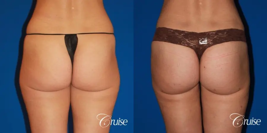 best bbl in newport beach - Before and After