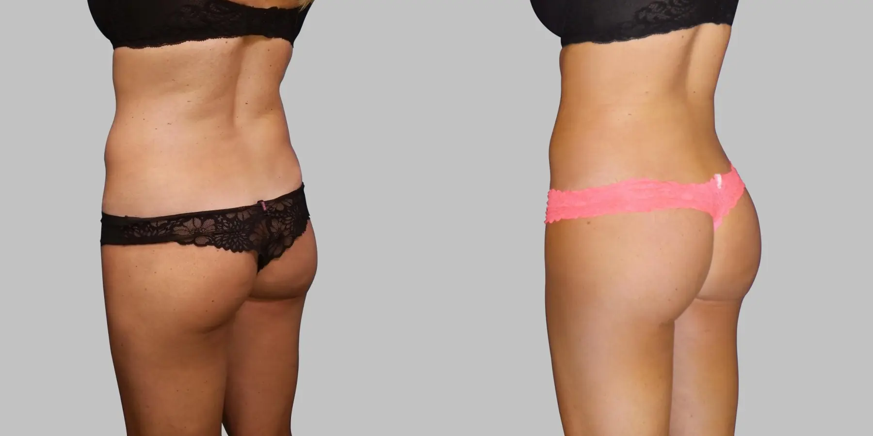 Brazilian Butt Lift: Patient 5 - Before and After 2