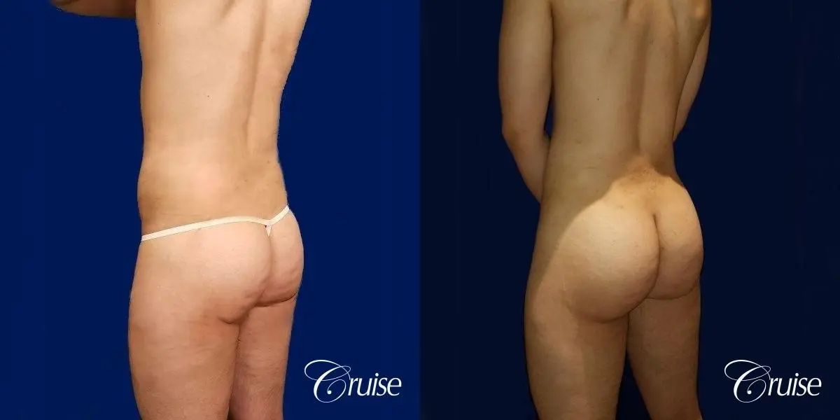 Brazilian Butt Lift - Before and After 3