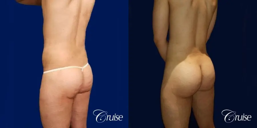 Brazilian Butt Lift - Before and After 3