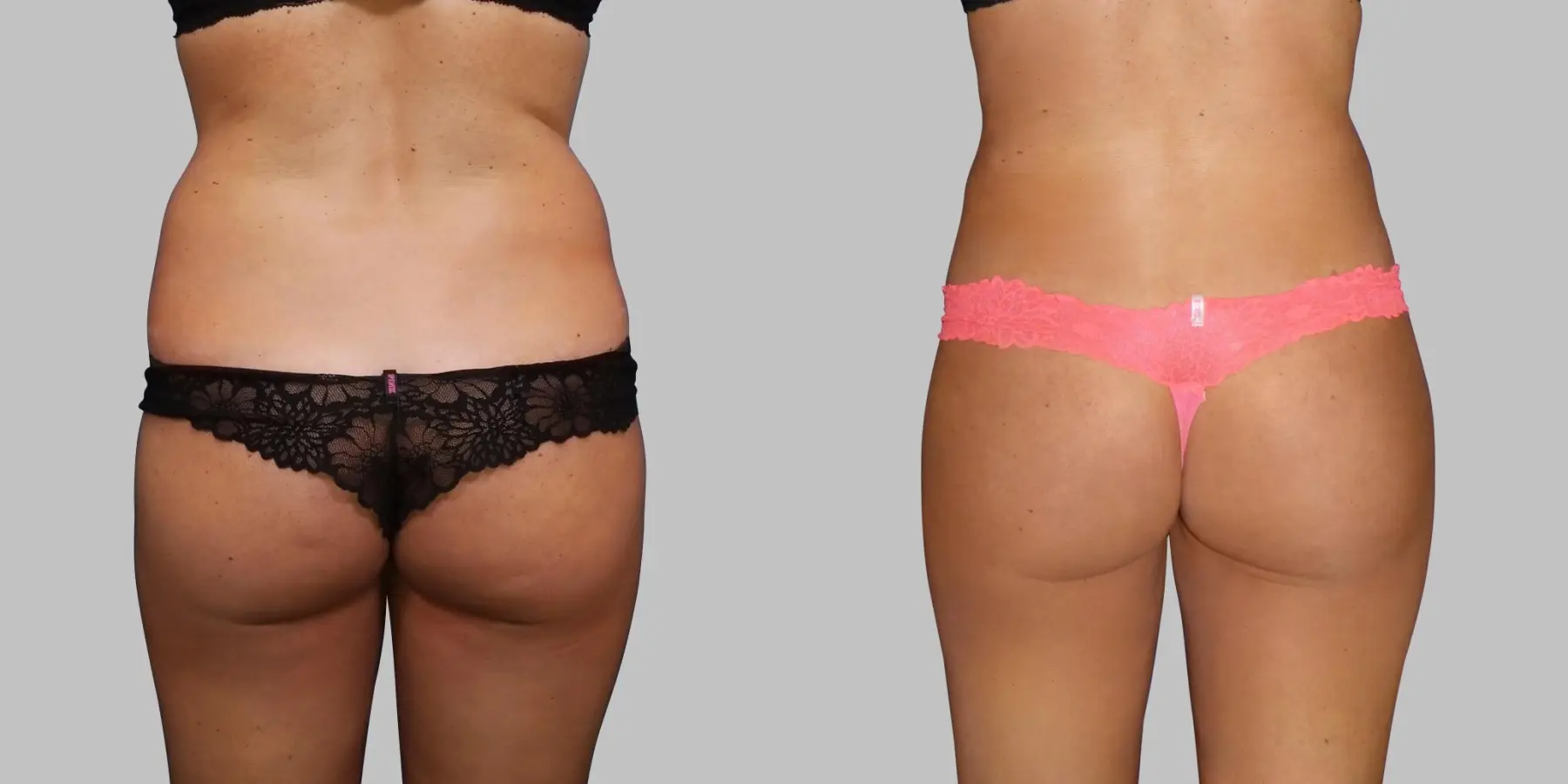 Brazilian Butt Lift: Patient 5 - Before and After  