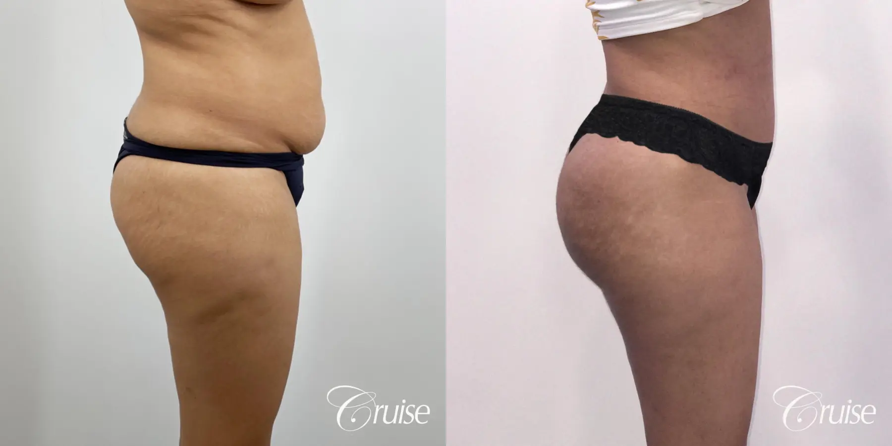 Brazilian Butt Lift: Patient 22 - Before and After 5