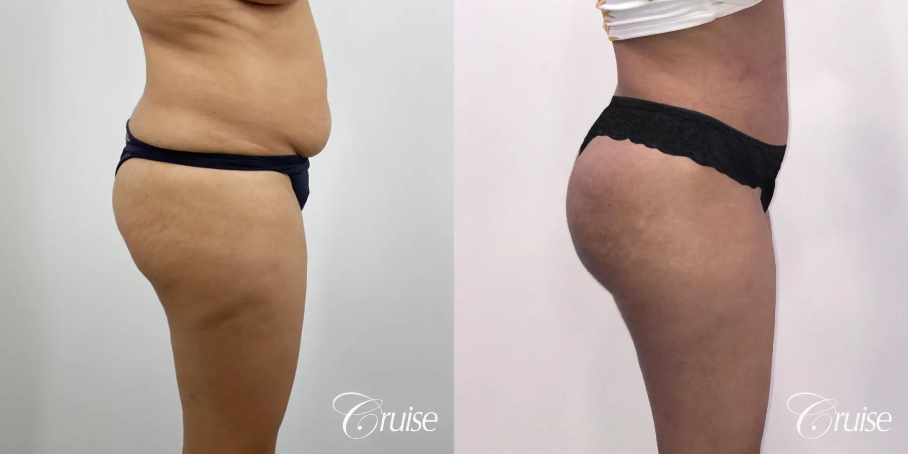 Brazilian Butt Lift: Patient 25 - Before and After 5