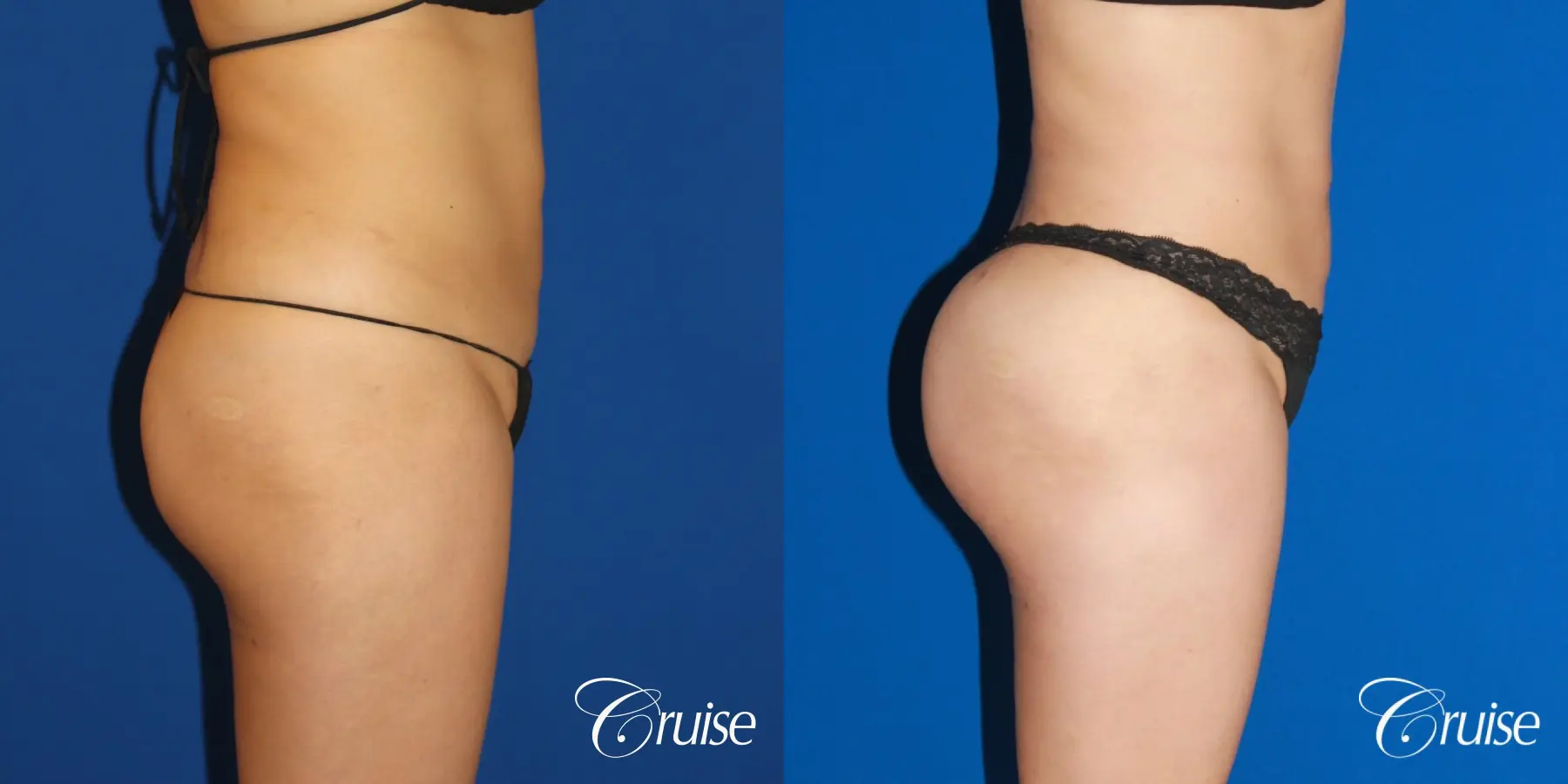 Brazilian Butt Lift, Lipo Flanks and Thighs - Before and After 4