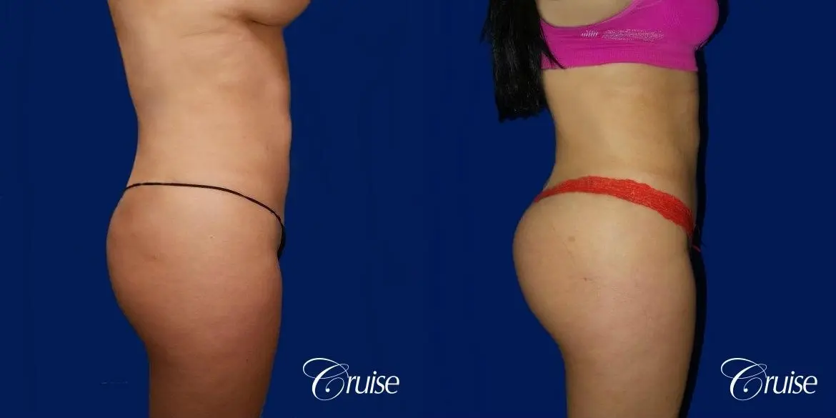 Brazilian Butt Lift - Before and After 3