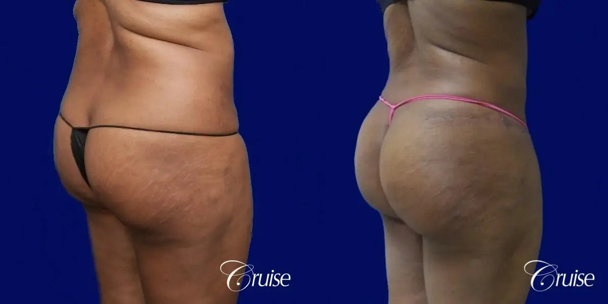 Brazilian Butt Lift  - Before and After 3