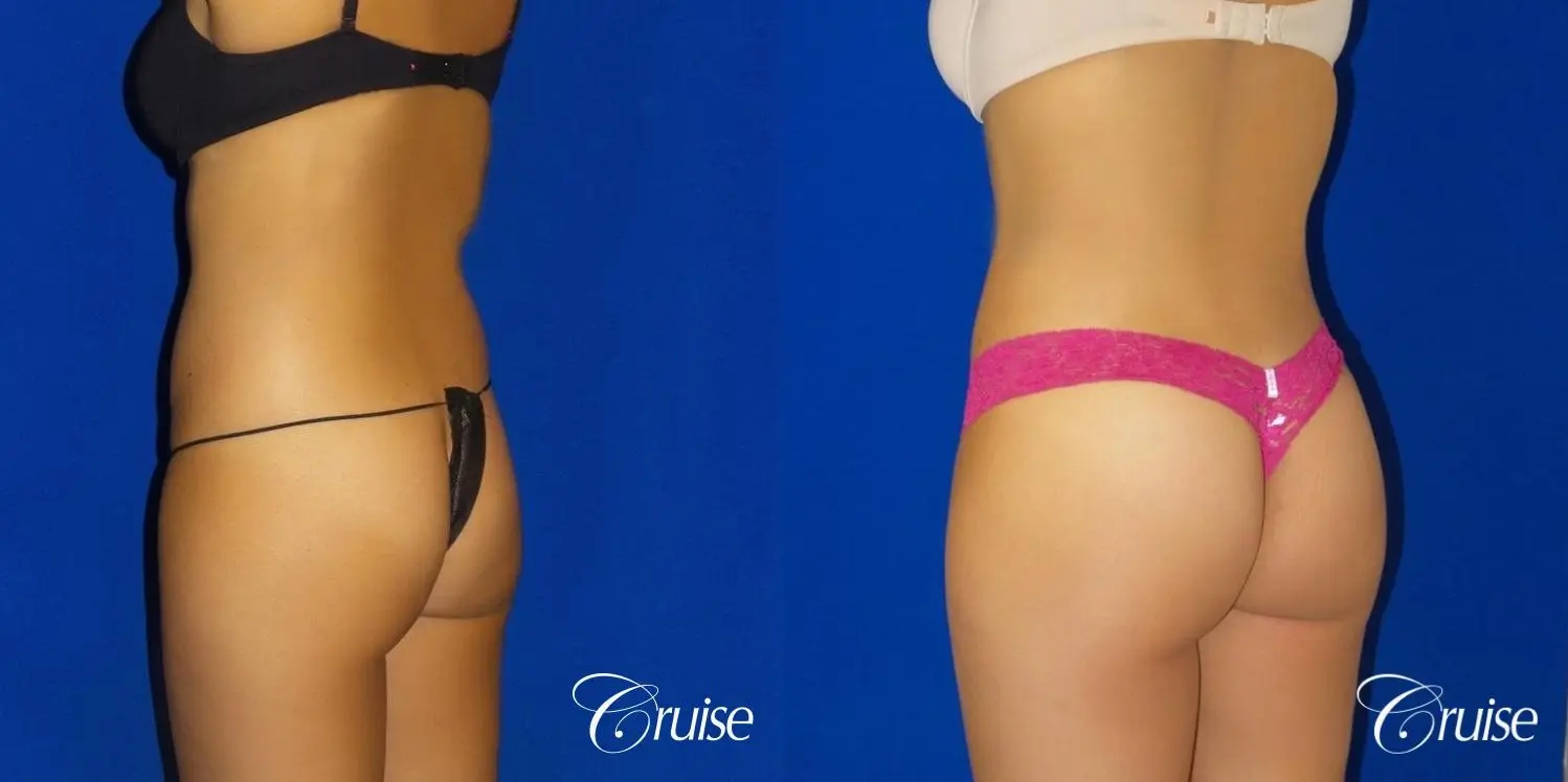 Brazilian Butt Lift - Before and After 3