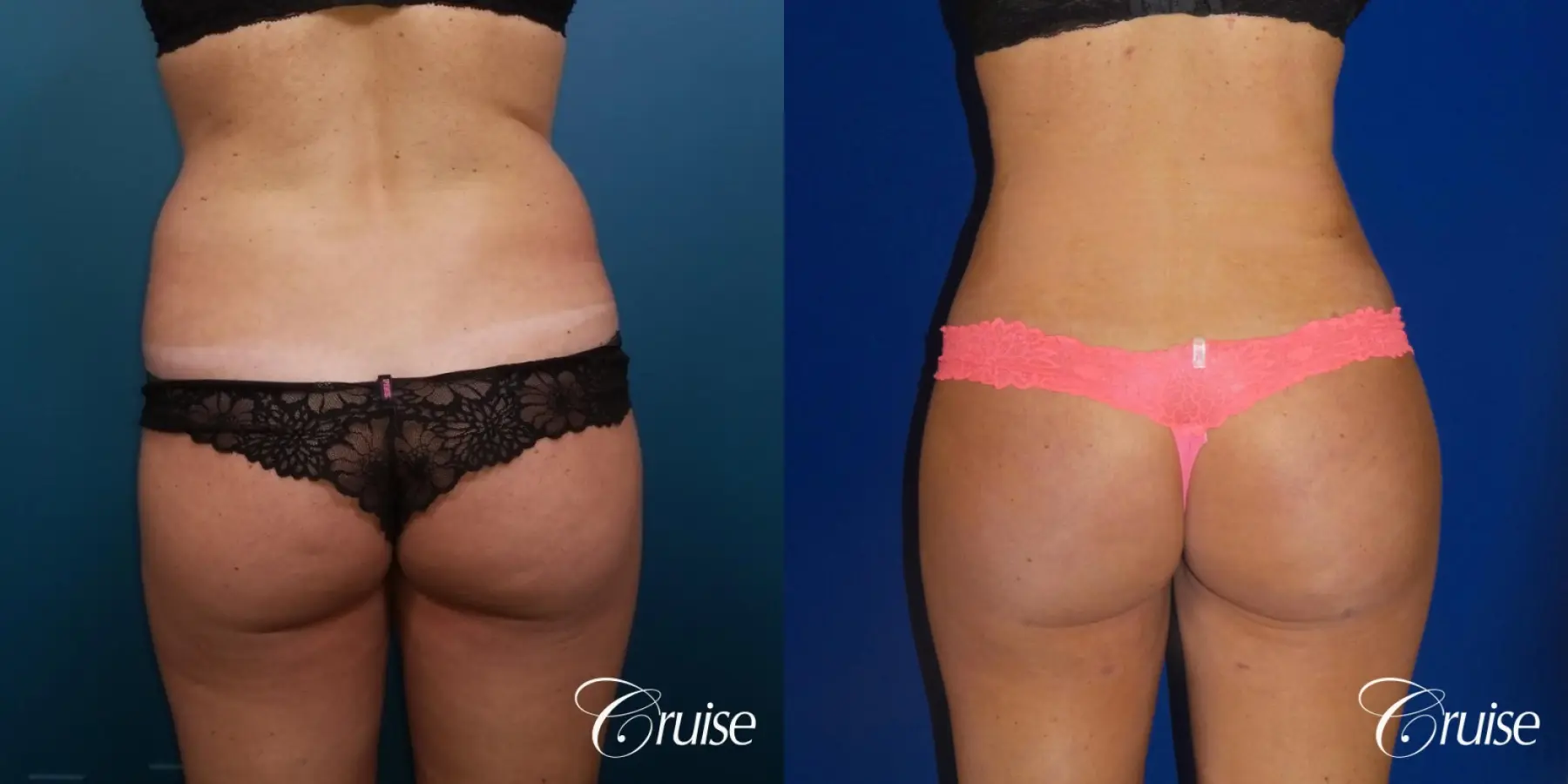 Brazilian Butt Lift: Patient 4 - Before and After  
