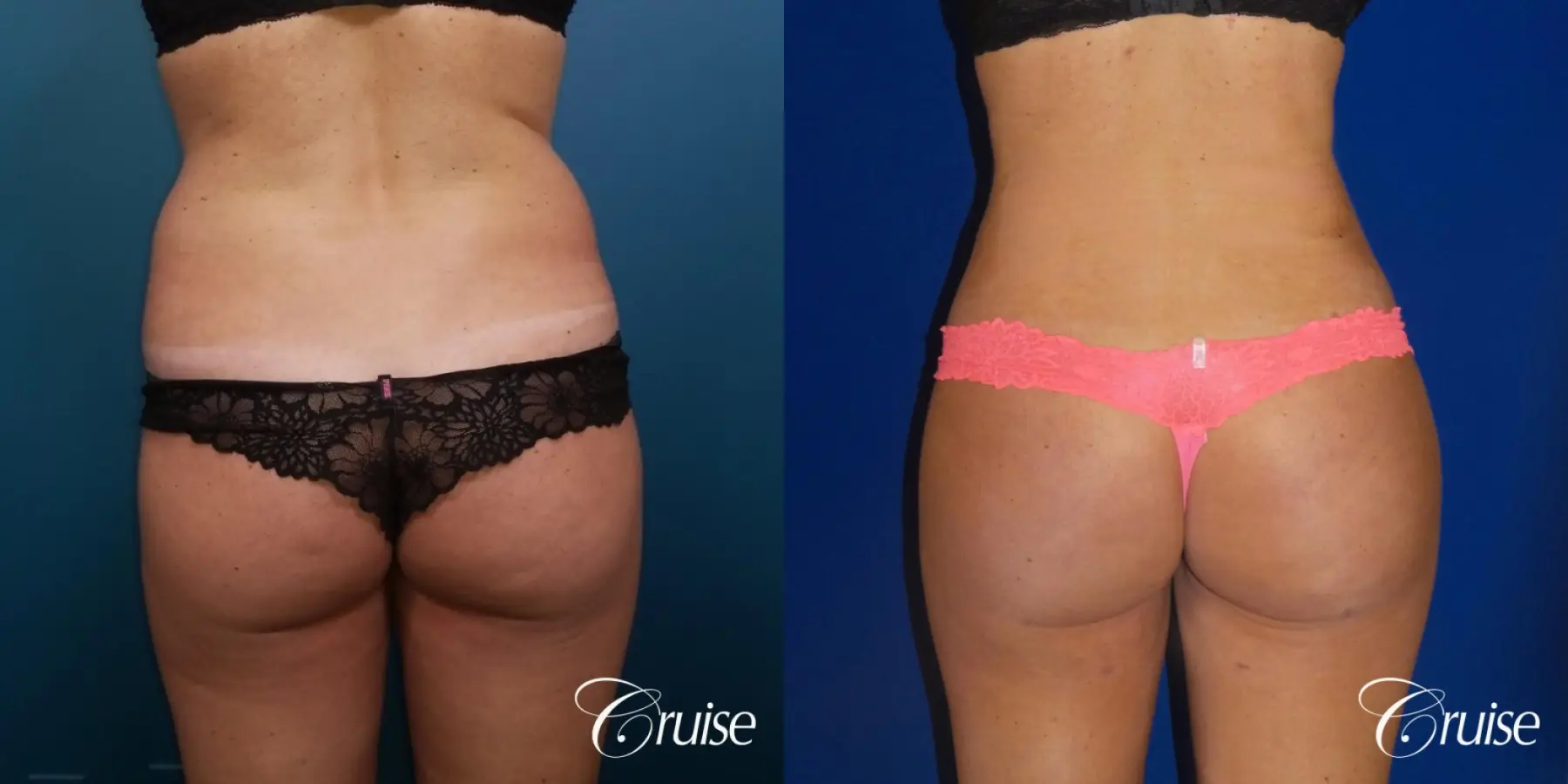 Brazilian Butt Lift: Patient 4 - Before and After 1