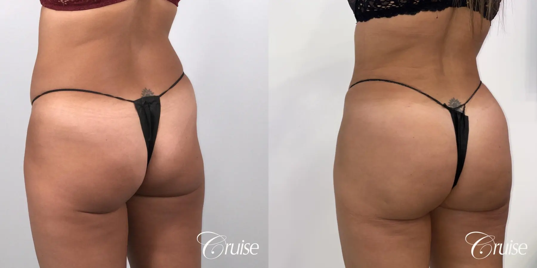 Brazilian Butt Lift: Patient 29 - Before and After 2