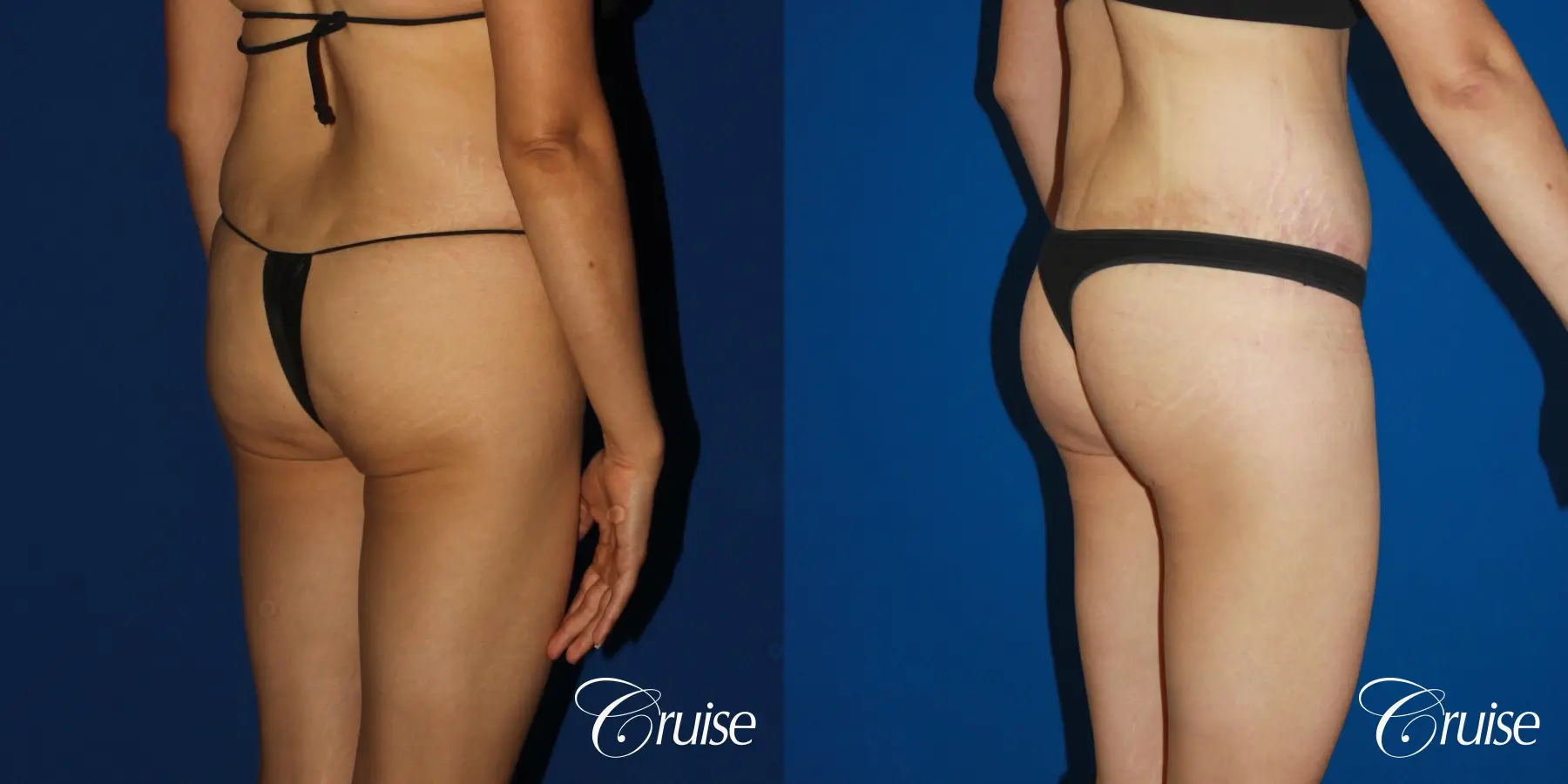 BBL, Lipo Flanks and Circumferential Tummy Tuck - Before and After 3