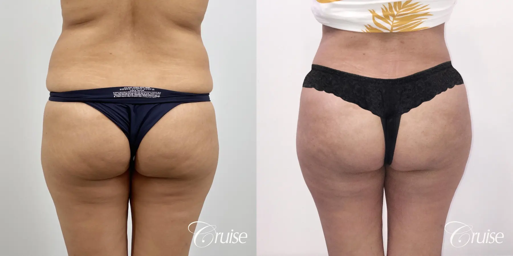 Brazilian Butt Lift: Patient 22 - Before and After 1