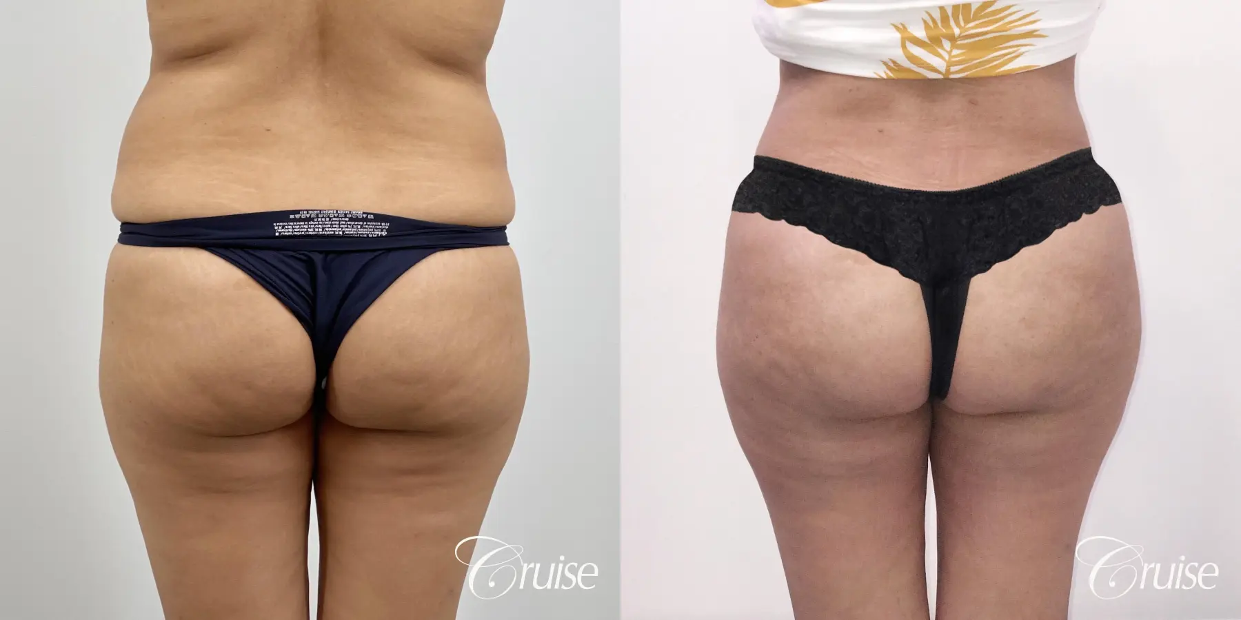 Brazilian Butt Lift: Patient 25 - Before and After 1