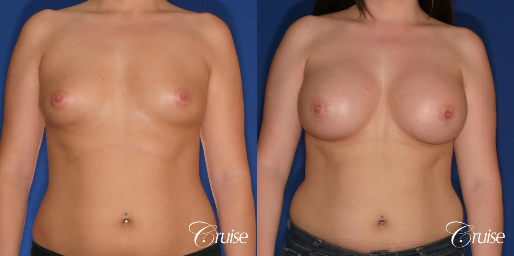 Breast Augmentation - Before and After 1