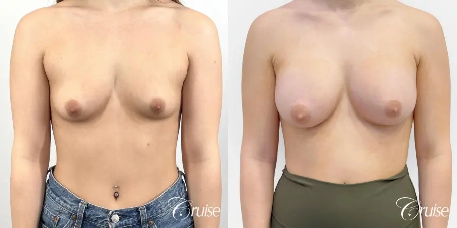 Silicone Gel Breast Implants - Before and After 1