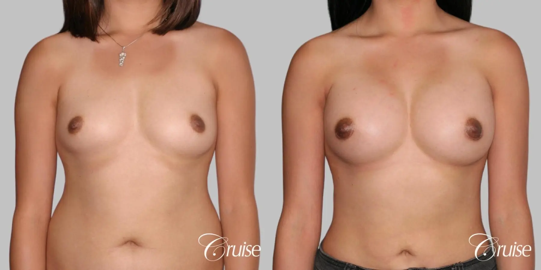 Breast Augmentation - Saline MP 285cc - Before and After 1