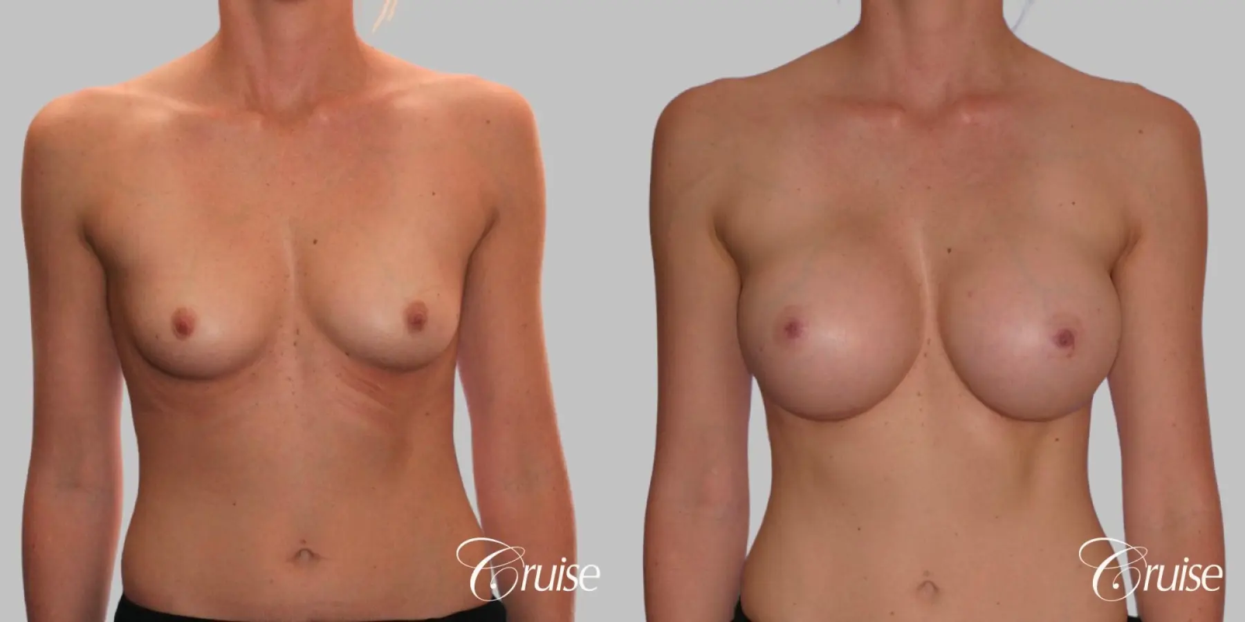 Breast Augmentation - Silicone HP 425cc - Before and After 1