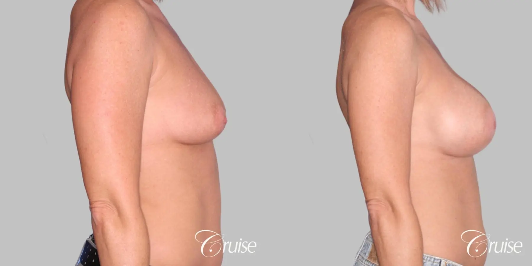Breast Augmentation - Before and After 3