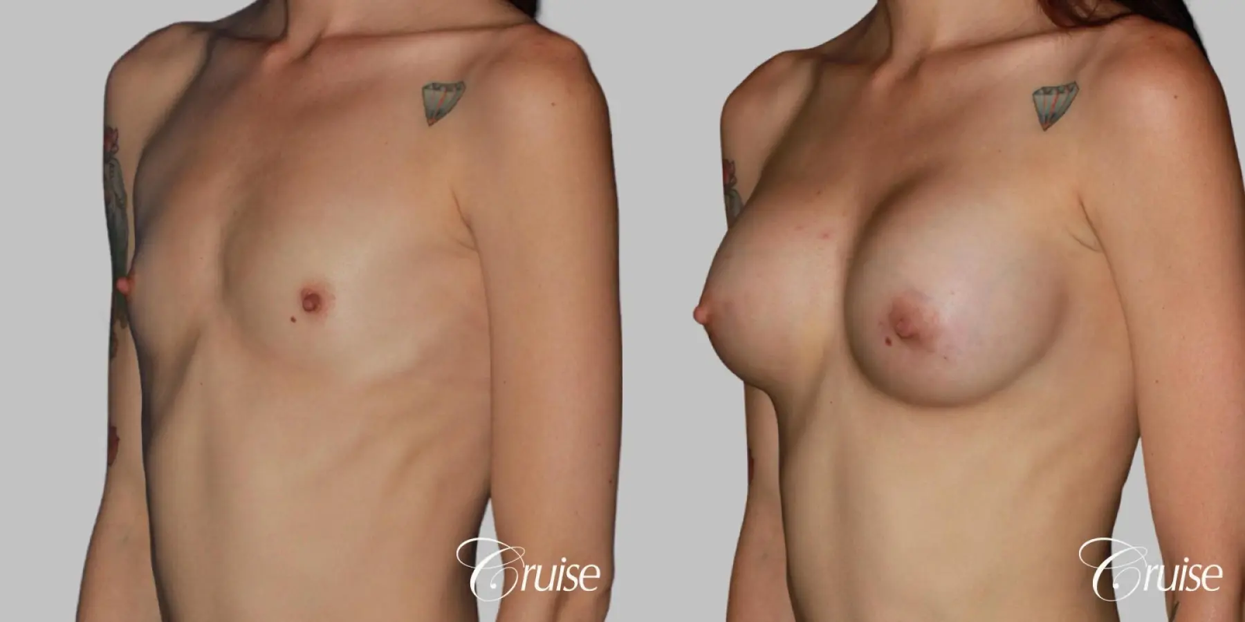 Breast Augmentation on Petite Patient - HP 375cc (silicone) - Before and After 2