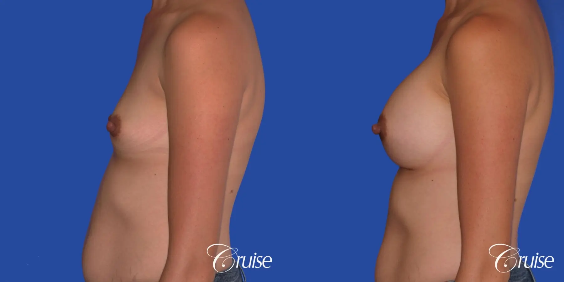 Breast Augmentation: Patient 43 - Before and After 2