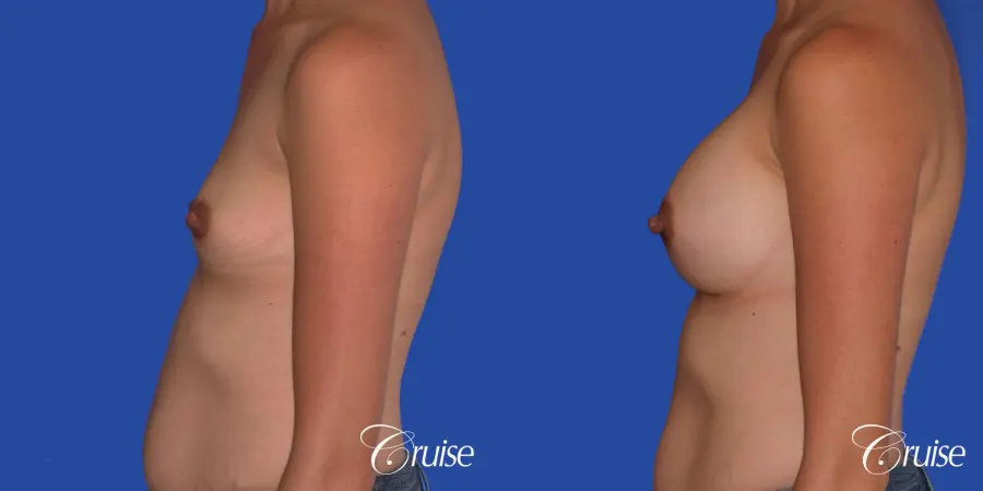 Breast Augmentation: Patient 42 - Before and After 2
