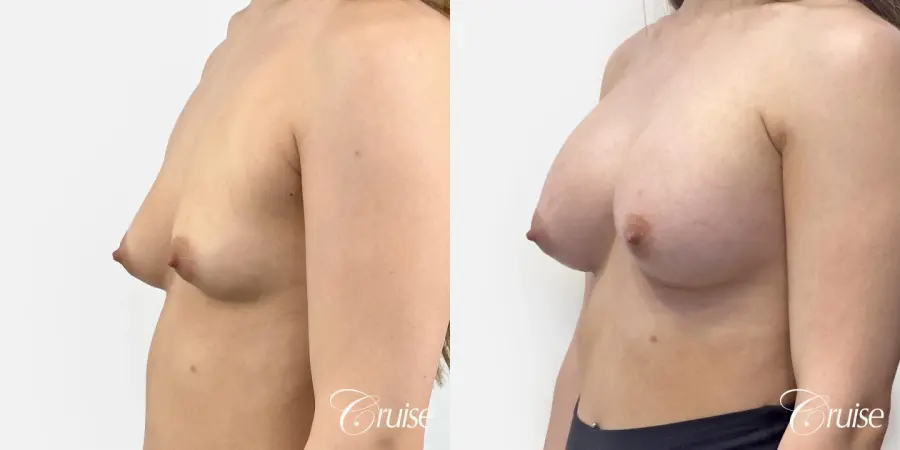 Silicone Gel Breast Implants - Before and After 4