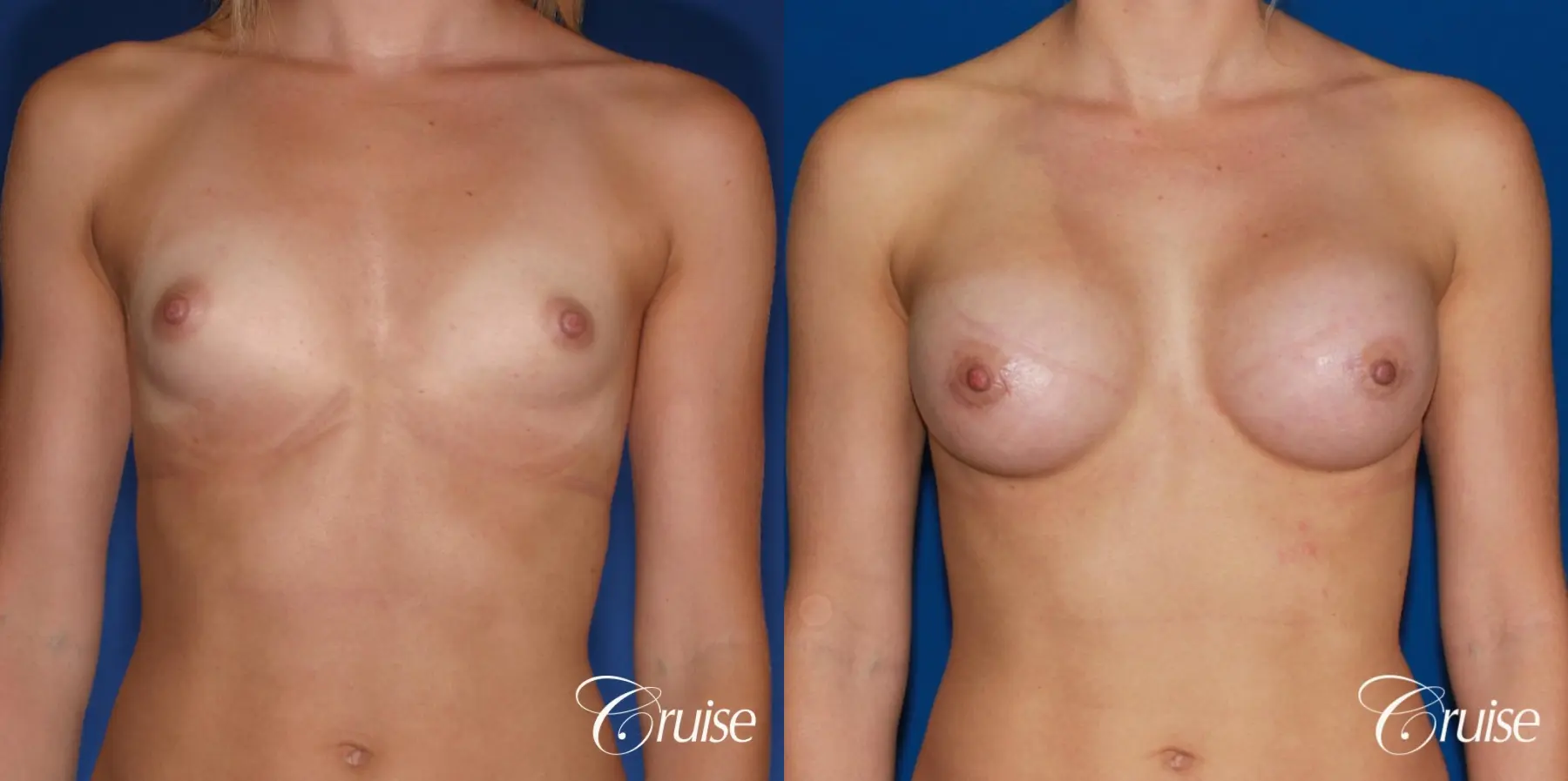 Breast Augmentation - Before and After 1