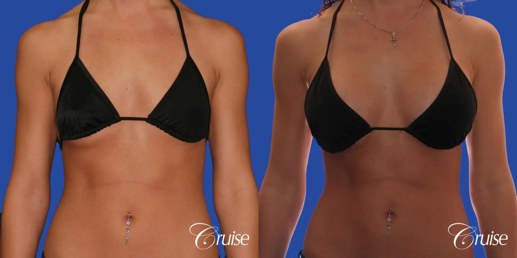 Breast Augmentation - Before and After 4