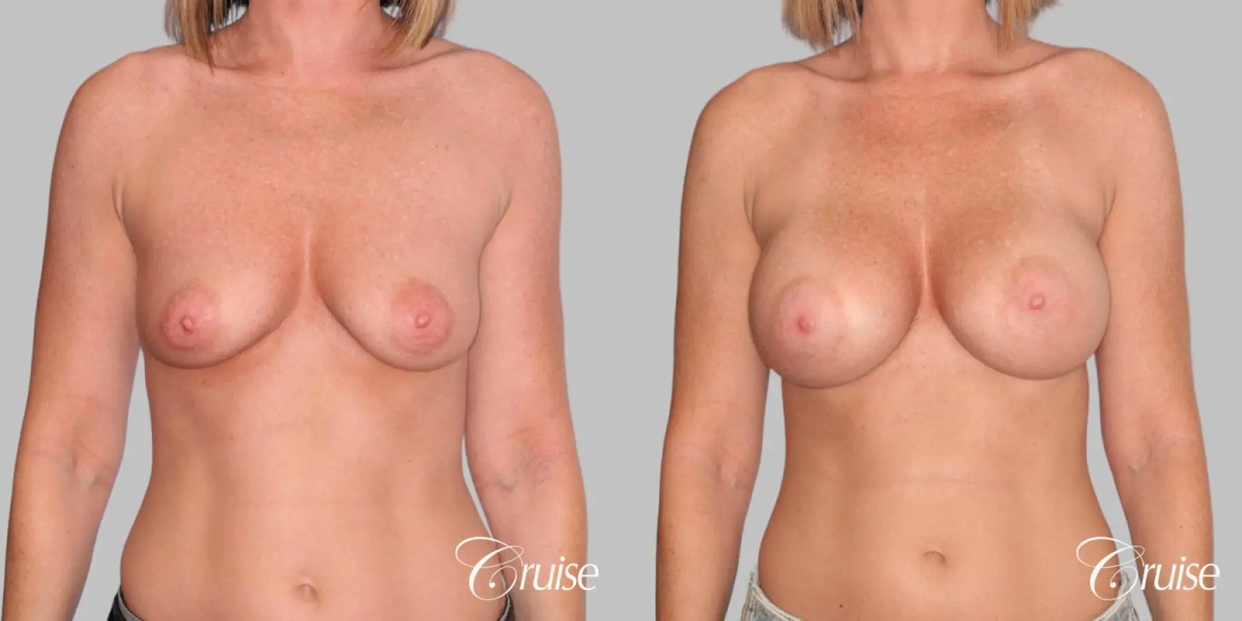 Breast Augmentation - Before and After 1