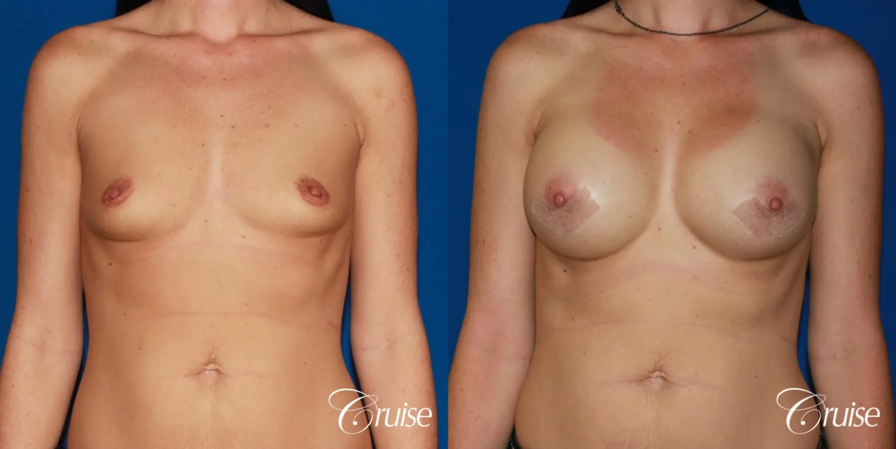 Breast Augmentation - Before and After 1