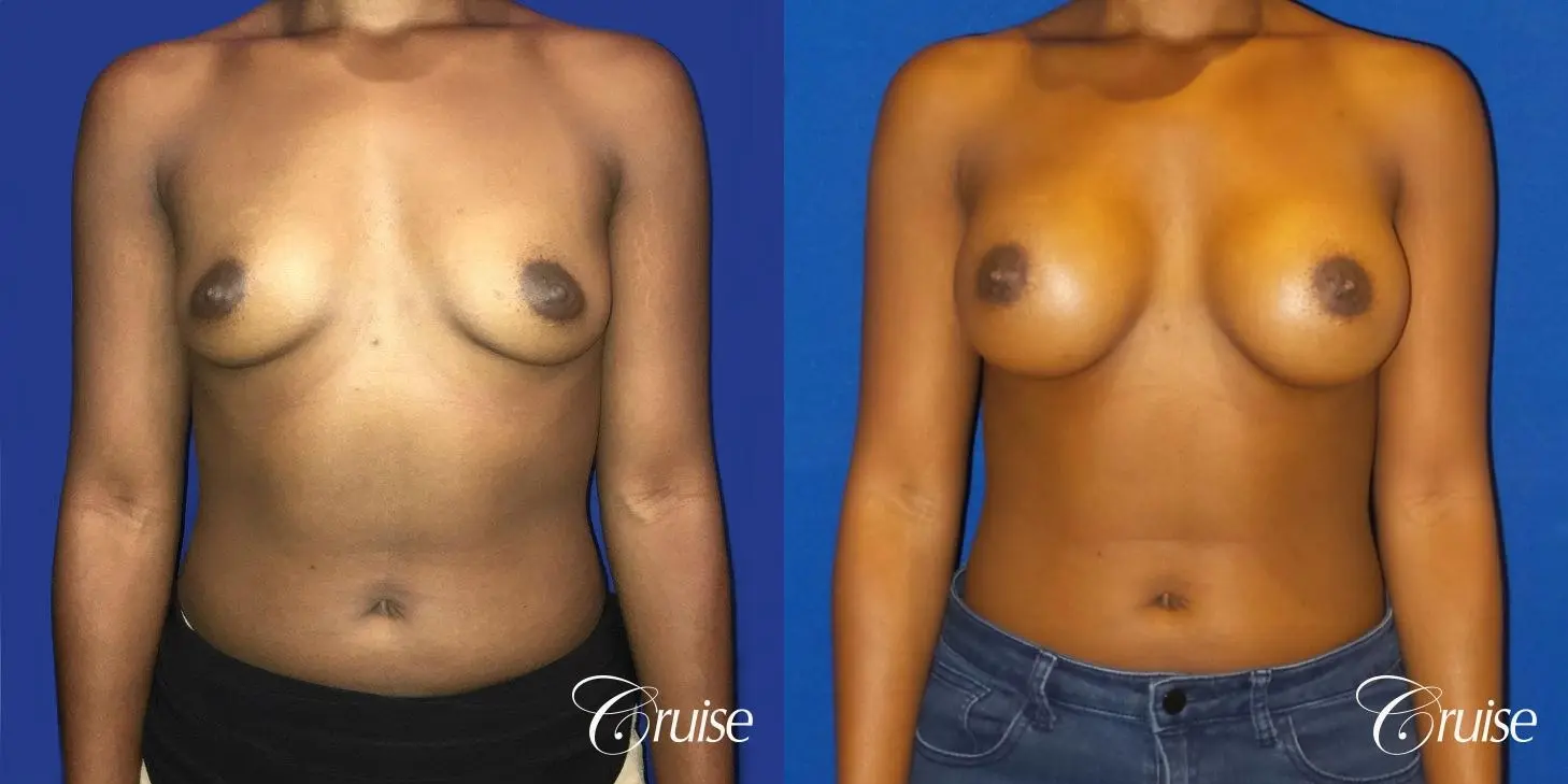 Breast Augmentation surgery Dr. Cruise - Before and After 1
