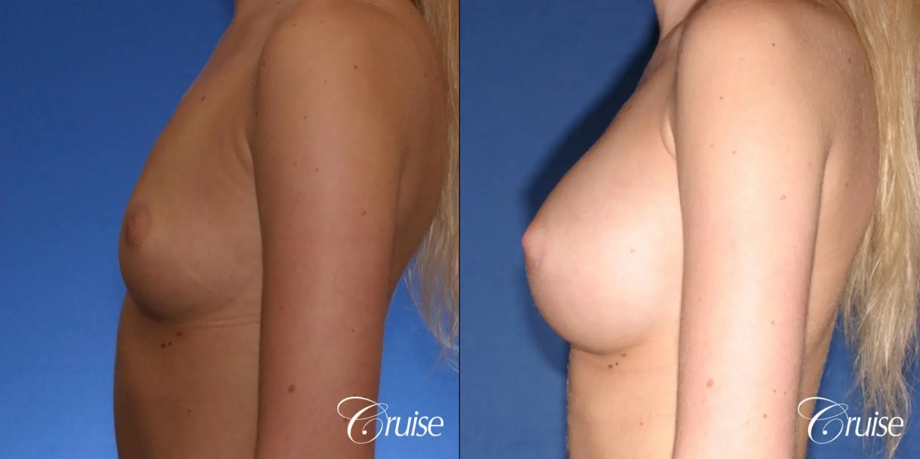 Breast Augmentation - Before and After 2