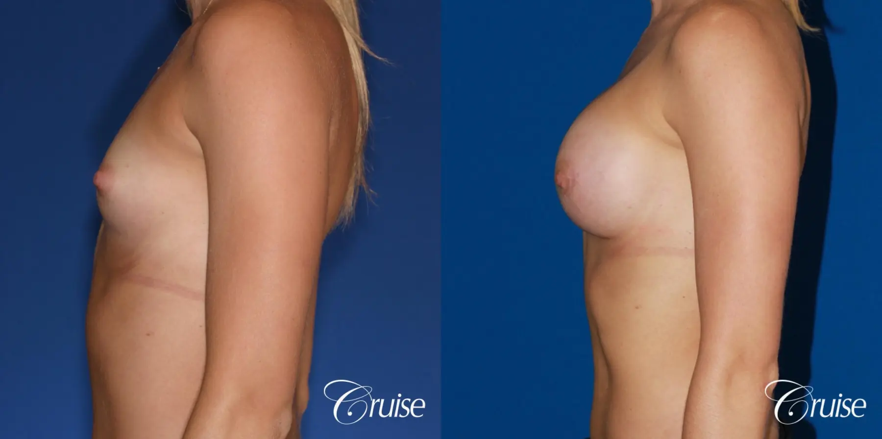 Breast Augmentation - Before and After 2